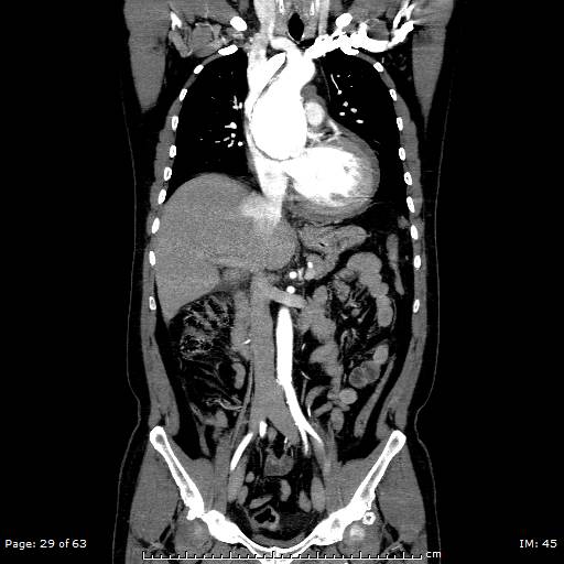 Ascending aortic aneurysm (Radiopaedia 50086-55404 B 29).jpg