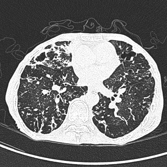 Aspergilloma- with Monod sign (Radiopaedia 44737-48532 Axial lung window 159).jpg
