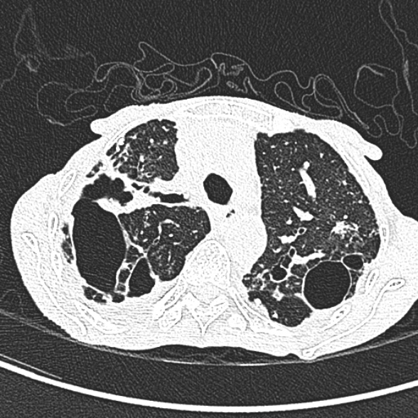 Aspergilloma- with Monod sign (Radiopaedia 44737-48532 Axial lung window 86).jpg