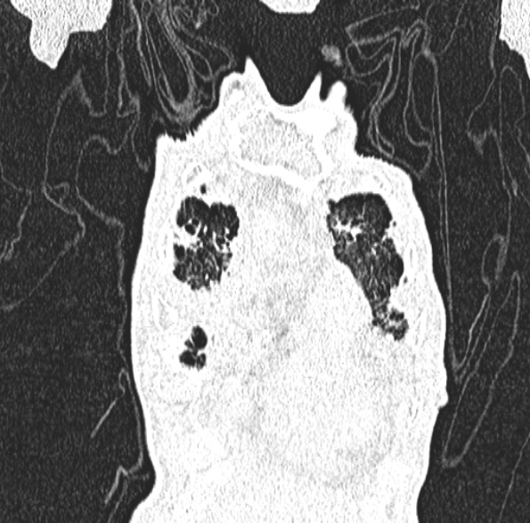 Aspergilloma- with Monod sign (Radiopaedia 44737-48532 Coronal lung window 133).jpg
