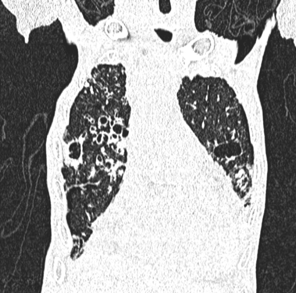 File:Aspergilloma- with Monod sign (Radiopaedia 44737-48532 Coronal lung window 170).jpg