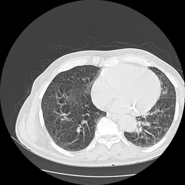 Aspergilloma (Radiopaedia 44592-48327 Axial lung window 63).jpg
