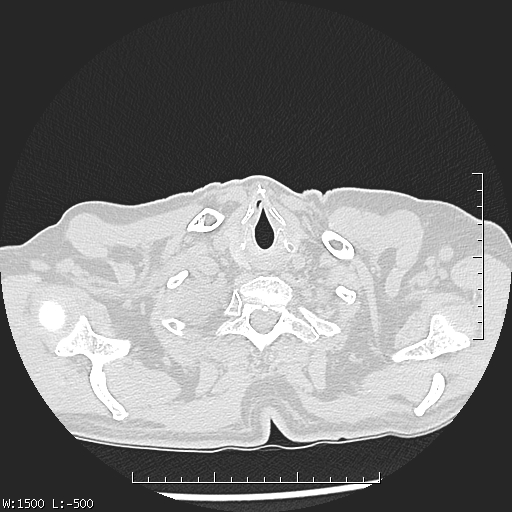 Aspergilloma (Radiopaedia 75184-86270 Axial lung window 2).jpg