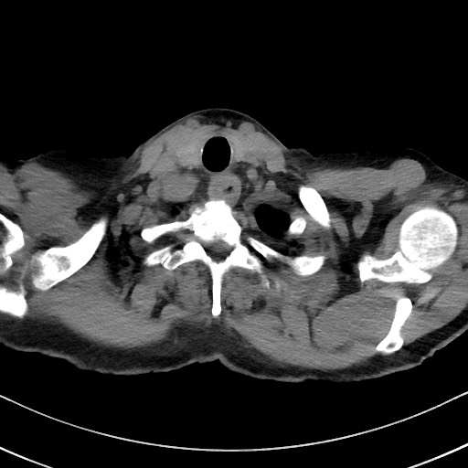 Aspergilloma on background pulmonary fibrosis (Radiopaedia 60942-68757 Axial non-contrast 4).jpg