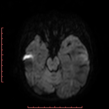 Astroblastoma (Radiopaedia 74287-85162 Axial DWI 32).jpg