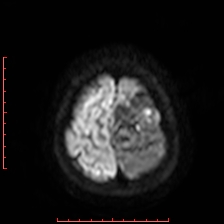 Astroblastoma (Radiopaedia 74287-85162 Axial DWI 99).jpg