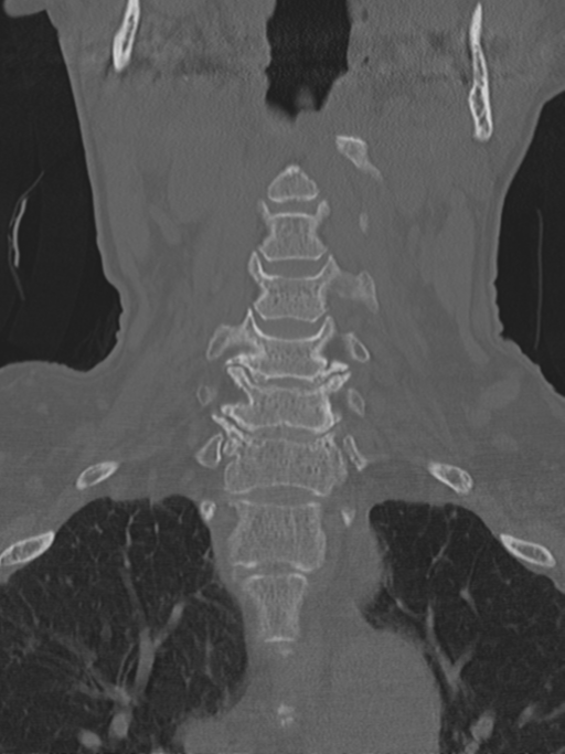 Atlanto-axial subluxation (Radiopaedia 36610-38176 Coronal bone window 16).png