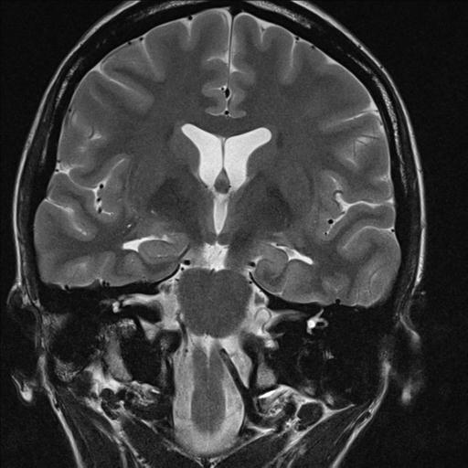 File:Atretic encephalocoele with inferior vermis hypoplasia (Radiopaedia 30443-31108 Coronal T2 8).jpg