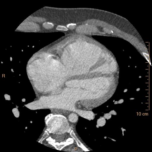 Atrial septal defect (upper sinus venosus type) with partial anomalous pulmonary venous return into superior vena cava (Radiopaedia 73228-83961 A 145).jpg