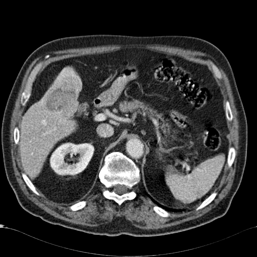 Atypical hepatocellular carcinoma (Radiopaedia 41744-44698 B 26).jpg