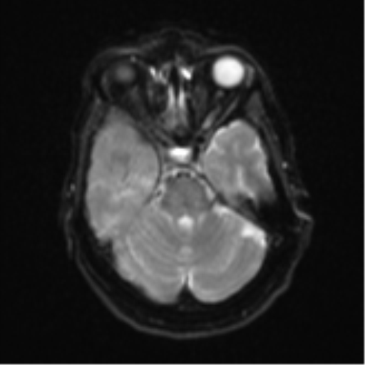 Atypical meningioma (WHO Grade II) (Radiopaedia 54742-60979 Axial DWI 9).png