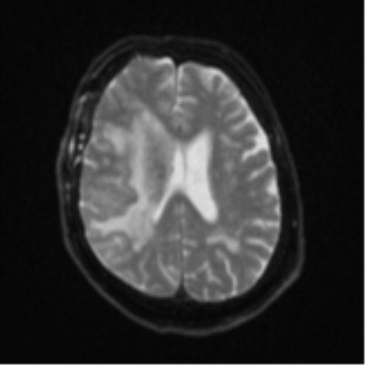 Atypical meningioma (WHO Grade II) (Radiopaedia 54742-60981 Axial DWI 18).png