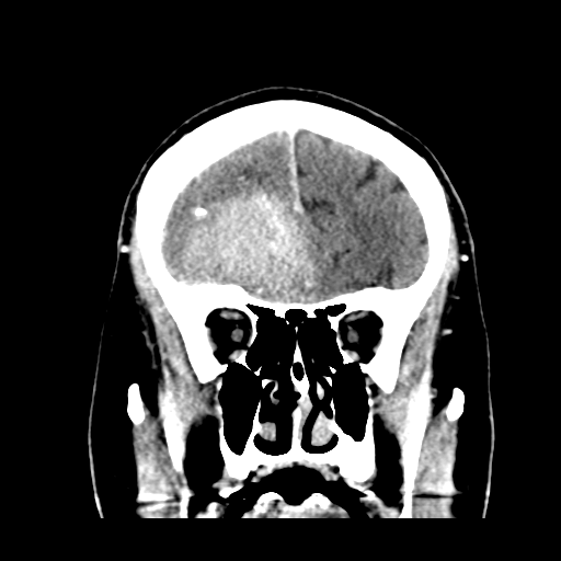 File:Atypical meningioma (WHO grade II) with brain invasion (Radiopaedia 57767-64728 Coronal C+ 17).png