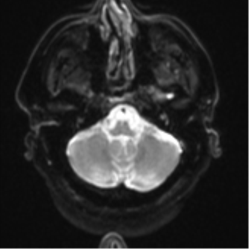 Atypical meningioma (WHO grade II) with brain invasion (Radiopaedia 57767-64729 Axial DWI 6).png