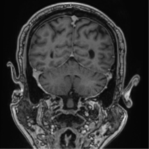 File:Atypical meningioma (WHO grade II) with brain invasion (Radiopaedia 57767-64729 Coronal T1 C+ 63).png