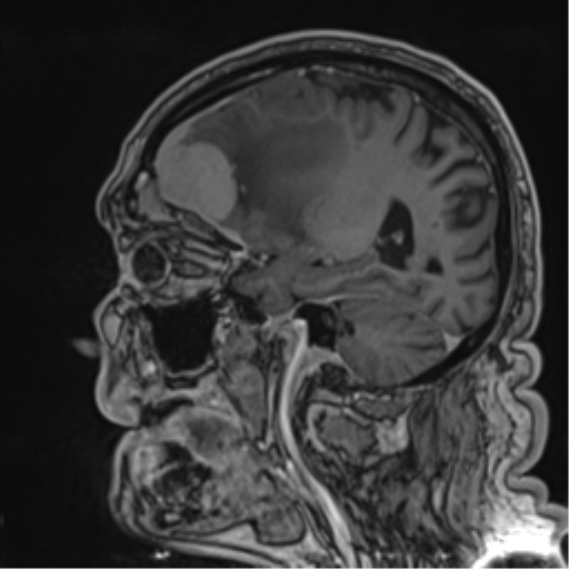 Atypical meningioma (WHO grade II) with brain invasion (Radiopaedia 57767-64729 Sagittal T1 C+ 45).png