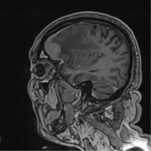 Atypical meningioma (WHO grade II) with brain invasion (Radiopaedia 57767-64729 Sagittal T1 C+ 49).png