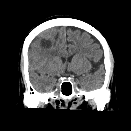 Atypical meningioma (WHO grade II) with osseous invasion (Radiopaedia 53654-59715 Coronal non-contrast 28).png