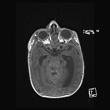 Atypical teratoid rhabdoid tumor (prenatal US and neonatal MRI) (Radiopaedia 59091-66388 Axial T1 23).jpg