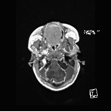 File:Atypical teratoid rhabdoid tumor (prenatal US and neonatal MRI) (Radiopaedia 59091-66388 Axial T1 C+ 10).jpg