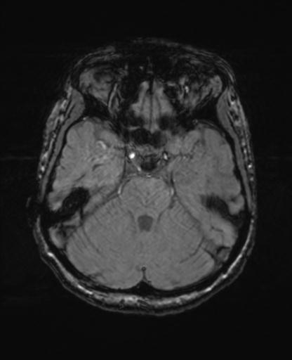 Autoimmune limbic encephalitis (Radiopaedia 30363-31005 SWI - magnitude 24).jpg