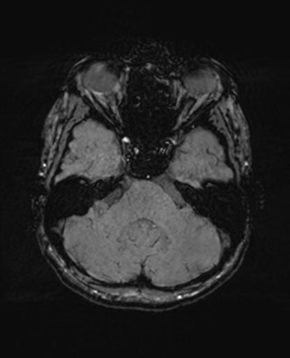 Autoimmune limbic encephalitis (Radiopaedia 30363-31005 SWI 20).jpg