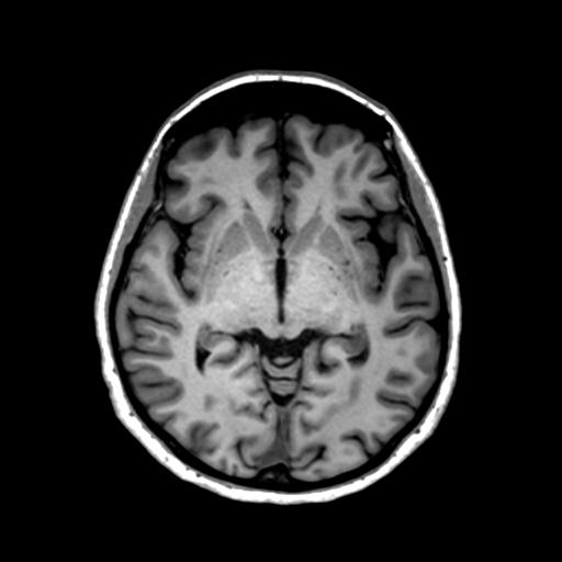 Autoimmune limbic encephalitis (Radiopaedia 30363-31005 T1 Axial 1mm 72).jpg