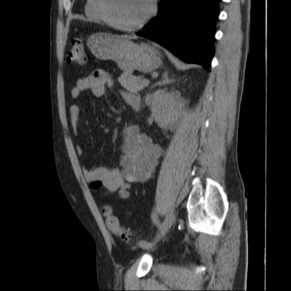 Autosomal dominant polycystic kidney disease (Radiopaedia 36539-38101 D 54).jpg