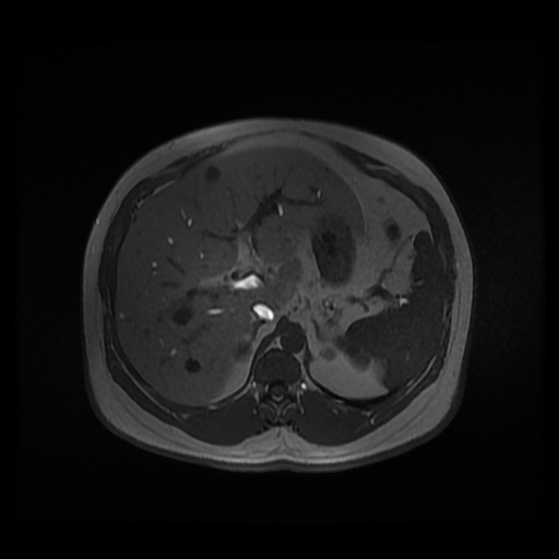 Autosomal dominant polycystic kidney disease (Radiopaedia 50259-55611 Axial 2D Dual Echo 30).jpg
