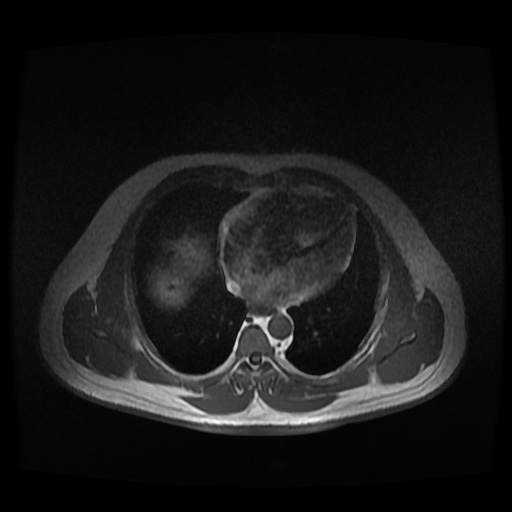 File:Autosomal dominant polycystic kidney disease (Radiopaedia 50259-55611 Axial 2D Dual Echo 4).jpg