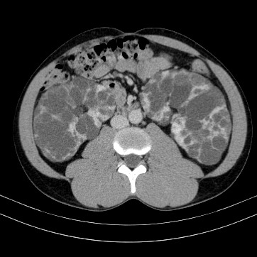 Autosomal dominant polycystic kidney disease (Radiopaedia 66349-75582 B 52).jpg