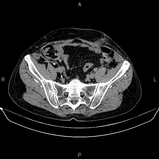 File:Autosomal dominant polycystic kidney disease (Radiopaedia 87830-104287 Axial non-contrast 44).jpg