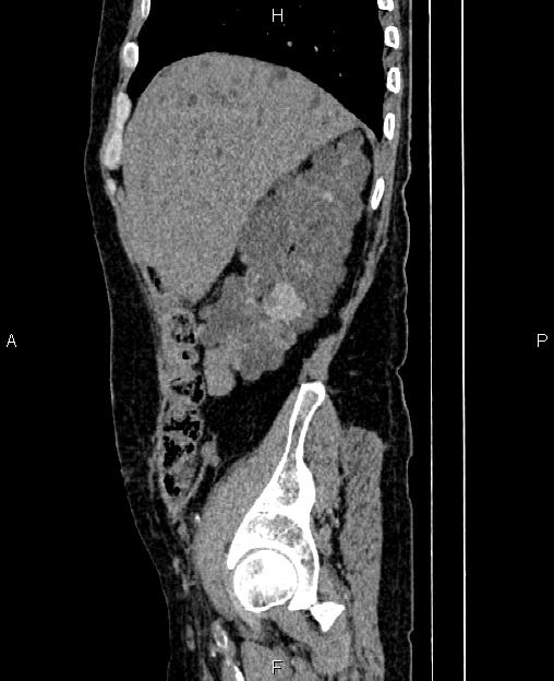 Autosomal dominant polycystic kidney disease (Radiopaedia 87830-104287 C 18).jpg