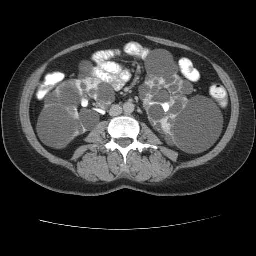 Autosomal dominant polycystic kidney disease with hepatic involvement (Radiopaedia 32693-33662 C 43).jpg