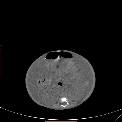 Autosomal recessive polycystic kidney disease associated with Caroli disease (Radiopaedia 61932-69984 Axial non-contrast 230).jpg