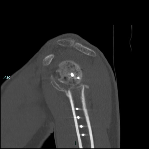 Avascular necrosis after fracture dislocations of the proximal humerus (Radiopaedia 88078-104653 Sagittal bone window 28).jpg