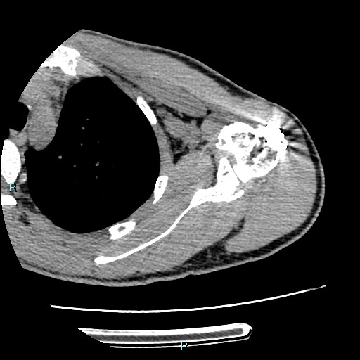 File:Avascular necrosis after fracture dislocations of the proximal humerus (Radiopaedia 88078-104655 D 57).jpg