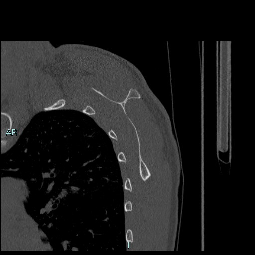 Avascular necrosis after fracture dislocations of the proximal humerus (Radiopaedia 88078-104655 Sagittal bone window 62).jpg