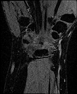 Avascular necrosis of the capitate (Radiopaedia 88317-104948 Coronal T1 vibe 57).jpg