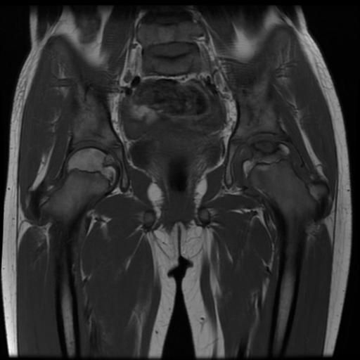File:Avascular necrosis of the hip (Radiopaedia 29563-30067 Coronal T1 8).jpg