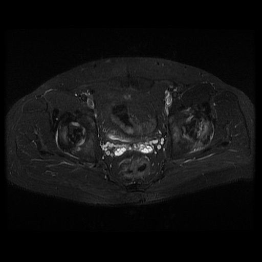 File:Avascular necrosis of the hip (Radiopaedia 61503-69465 Axial STIR 14).jpg