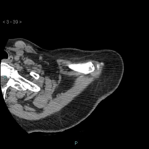 File:Avascular necrosis of the shoulder - Cruess stage I (Radiopaedia 77674-89887 Axial soft tissues 13).jpg