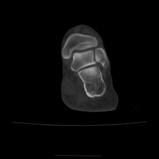 Avulsion fracture of the dorsal cuboid bone (Radiopaedia 51586-57377 Axial bone window 16).jpg