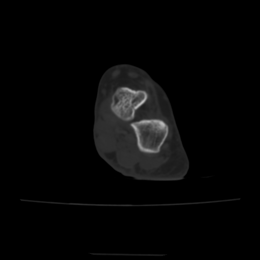 Avulsion fracture of the dorsal cuboid bone (Radiopaedia 51586-57377 Axial bone window 50).jpg