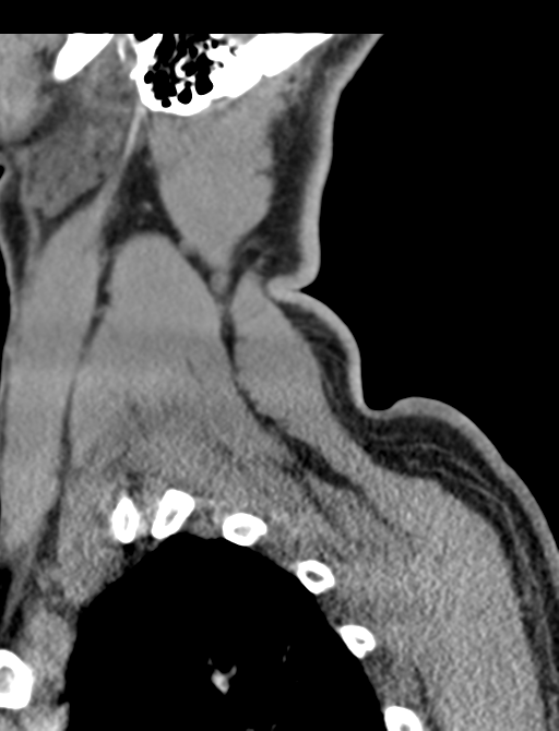 Axis peg fracture (type 3) and atlas lateral mass (type 4) fracture (Radiopaedia 37474-39324 D 70).png