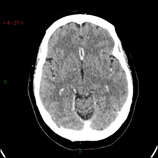 Azygos anterior cerebral artery (Radiopaedia 51987-57833 A 27).jpg