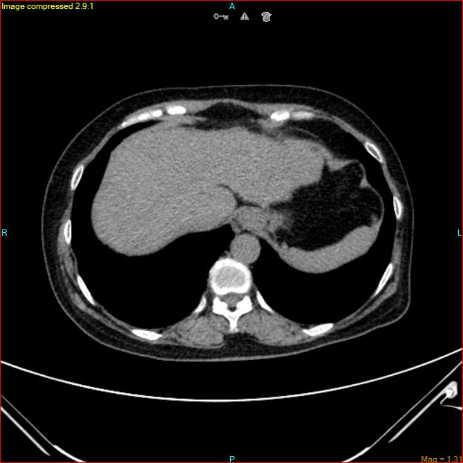 Azygos vein aneurysm (Radiopaedia 77824-90130 A 46).jpg
