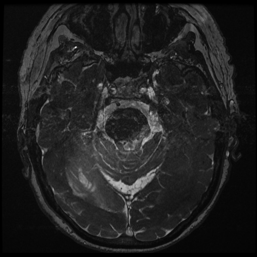 File:Balo concentric sclerosis (Radiopaedia 53875-59982 Axial T2 FIESTA 61).jpg