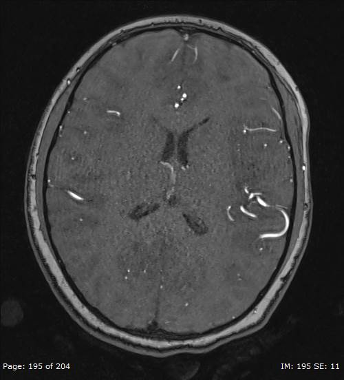 Balo concentric sclerosis (Radiopaedia 61637-69636 Axial MRA 195).jpg