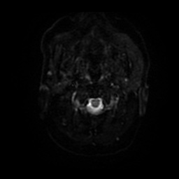 File:Basal cell carcinoma (periorbital) (Radiopaedia 55179-61559 Axial DWI 23).jpg